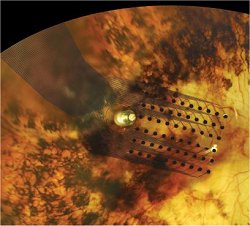 Retinas artificiais: Por que elas não geram imagens precisas?