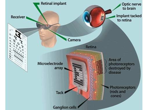 Olho biônico é aprovado para uso em pacientes