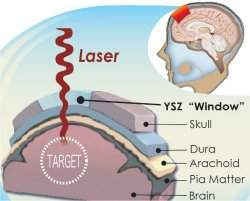 Implante transparente viabiliza tratamentos de luz no crebro