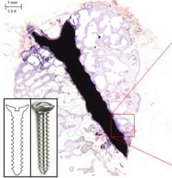 Liga de magnsio biodegradvel para implantes mdicos