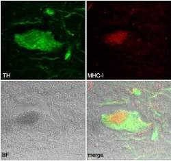 Alzheimer: Beta amiloide age como antibitico no crebro