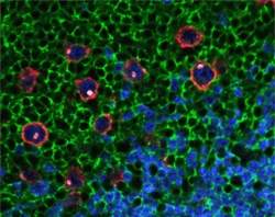 Nanopartículas coloridas identificam células raras de câncer