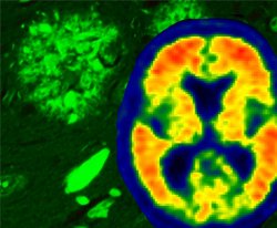 Proteínas tau, e não amiloides, podem ser causa de Alzheimer