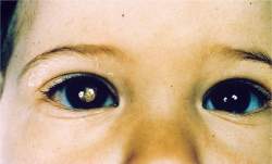 Brilho nos olhos permite diagnóstico de câncer em bebê