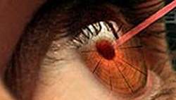 Laser com medicamento melhora tratamento da retinopatia