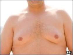 Reduo de mama em homens  a cirurgia plstica que mais cresce