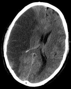 Aprenda a diagnosticar primeiros sinais de um derrame