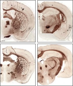 Alzheimer poder ser tratado com ultra-som