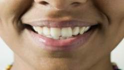 Verniz de titânio pode ser eficaz no combate à erosão dentária